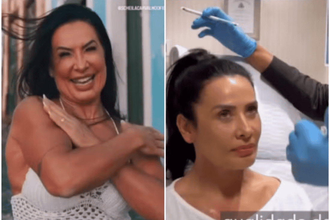 Scheila Carvalho sorridente após remover o preenchimento facial, mostrando um visual mais natural e rejuvenescida